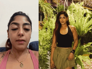 स्प्लिट्सविला स्पर्धकाचा दात तुटला, डोळ्यांना सूज आली:इंस्टाग्रामवर चेहऱ्याचा क्लोजअप दाखवला, प्रीत सिंहचा मुंबईतील क्लबमध्ये मारहाण झाल्याचा दावा
